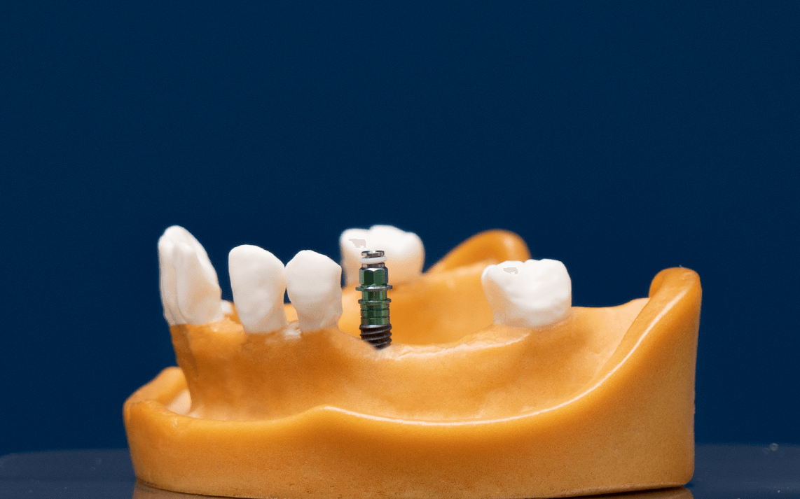 Implant Treatment Dent Lotus Tr